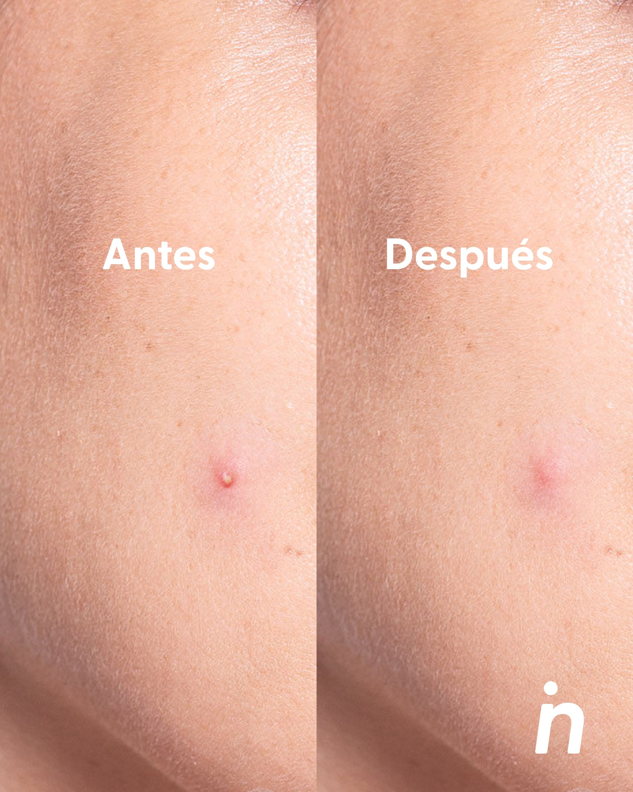 Pezoneras de Silicon - Nipskin® México